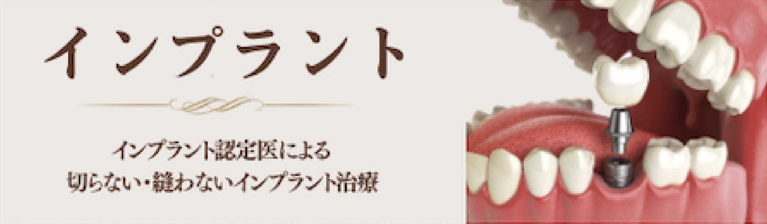 インプラント
