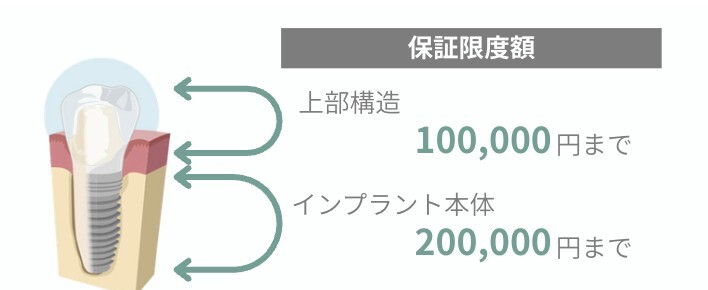 保証限度額：上部構造100,000円まで、インプラント本体200,000円まで